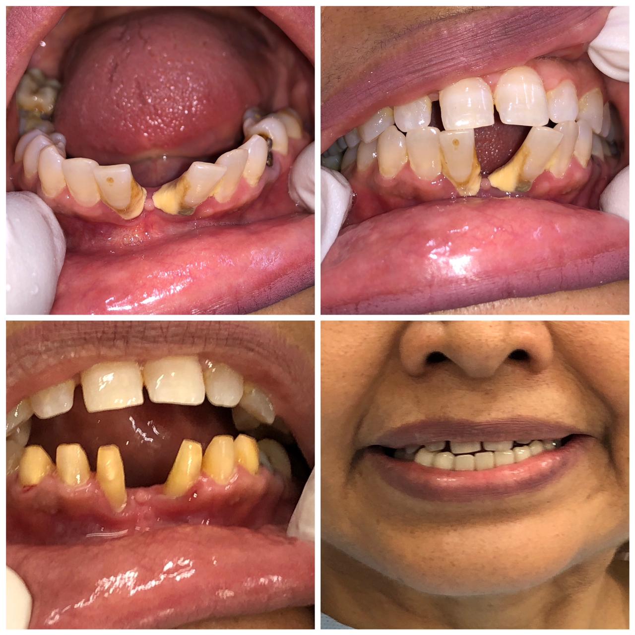 Zirconia Bridge